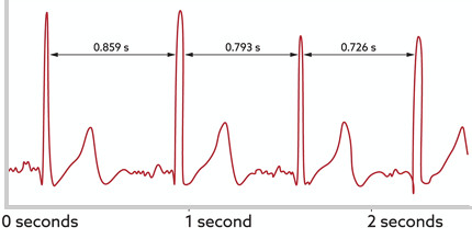 Using Biofeedback Devices to Measure Heart Rate Variability (HRV)